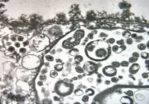 M, | cytomegalovirus - pneumonia